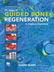 Cover von 20 Years of Guided Bone Regeneration in Implant Dentistry