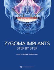 Cover von Zygoma Implants