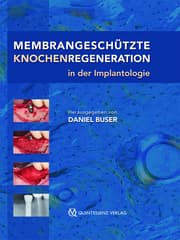 Cover von Membrangeschützte Knochenregeneration in der Implantologie