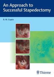Cover von An Approach to Successful Stapedectomy
